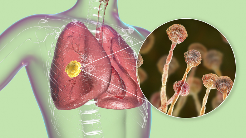 Pulmonary aspergillosis, invasion of a lung tissue by mold fungi Aspergillus with closeup view of the fungi, 3D illustration. Covid-19 complication